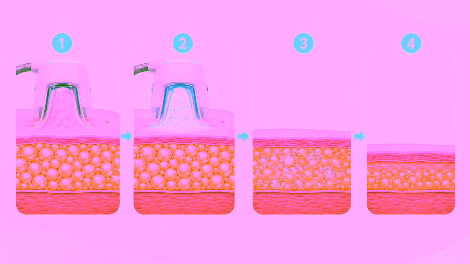 Four-stage illustration showing an applicator positioning tissue, controlled cooling of fat cells, gradual breakdown of affected cells and a reduced treated fat layer