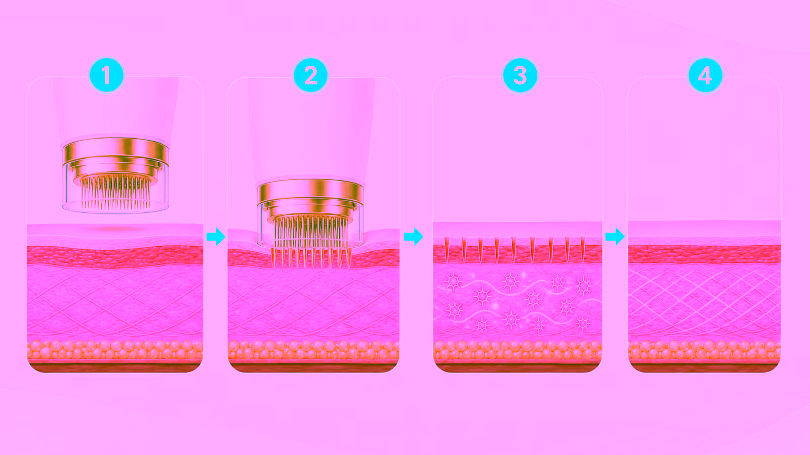 Illustration showing how MTS microneedling treatment works