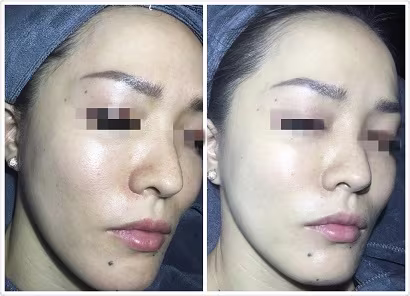 BB Glow Facial Treatment Promotion